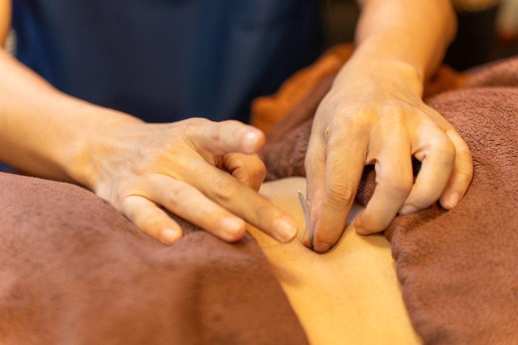 鍼灸ｒｉｃｃａの腰への鍼施術