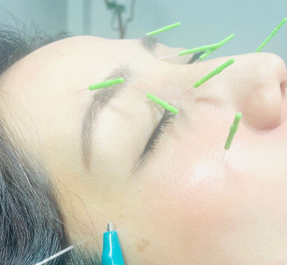 眼精疲労や頭痛に対しての鍼施術風景