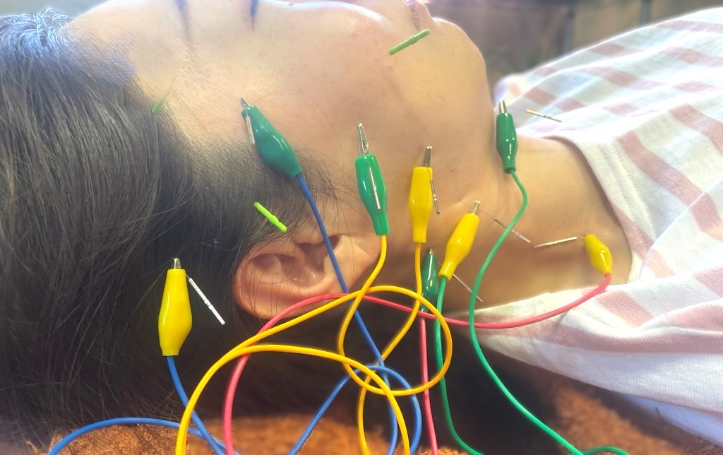 鍼灸riccaの美容鍼