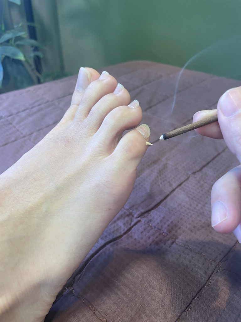 逆子のツボ、至陰(しいん)へのお灸施術