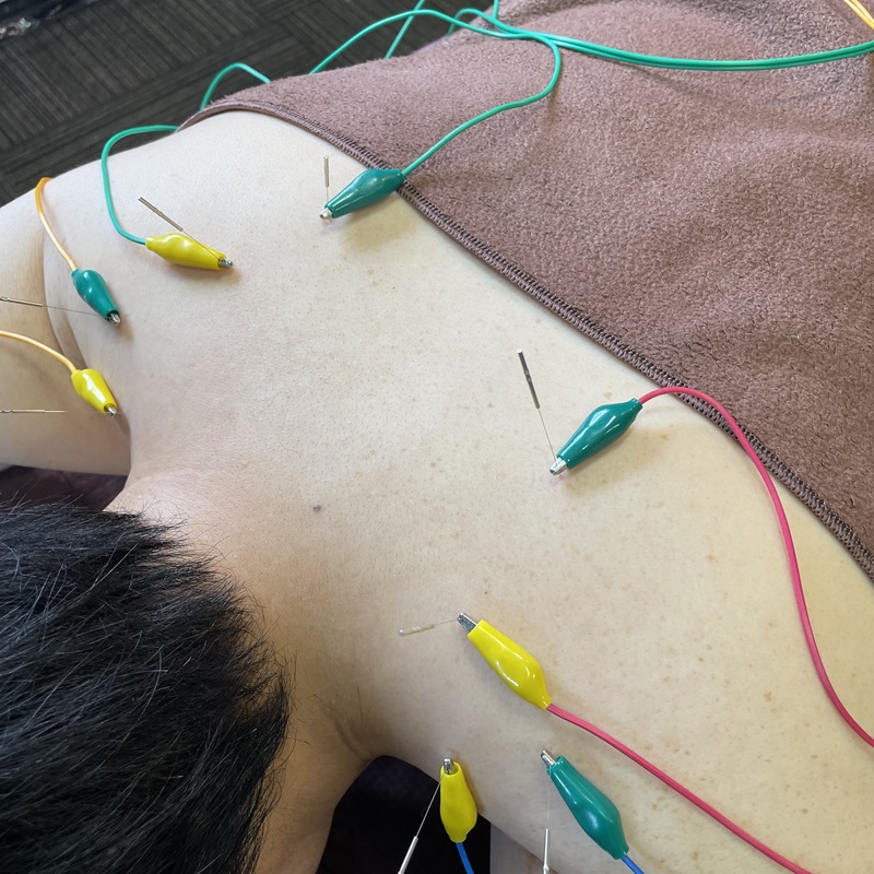 名古屋市中村区の鍼灸ｒｉｃｃａでおこなう肩こりに対しての電気鍼の施術風景